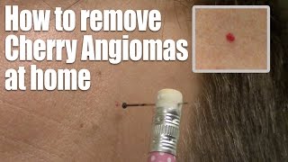 How to remove Red Skin Dots at home Quick amp Easy Cherry Angioma treatment [upl. by Higley]