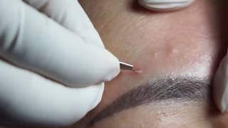 Acne Blackheads Whiteheads removals on face part 1 [upl. by Ellard]