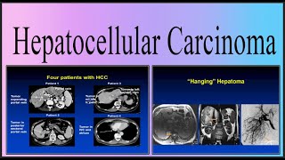 hepatocellular carcinoma [upl. by Weinman]