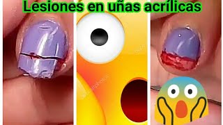 Lesiones en uñas acrílicas Primeros Auxilios en uñas acrílicas [upl. by Arria]