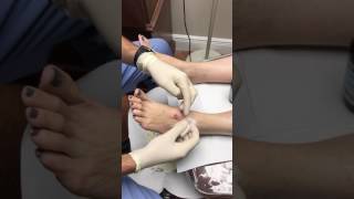 Aspiration and Drainage Cyst from Foot [upl. by Soiritos639]