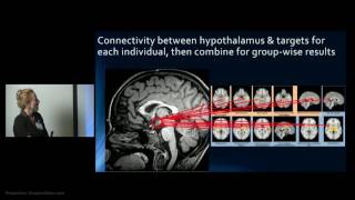 Hypothalamic Hamartoma Imaging Use in Diagnosis amp Management by Varina Boerwinkle [upl. by Otti]