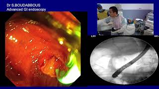 ERCP for acute cholangitis [upl. by Tiffi]