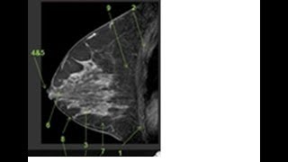 Behind the Scenes Sonography and Mammography Views of the Retromammary Space [upl. by Jarid797]