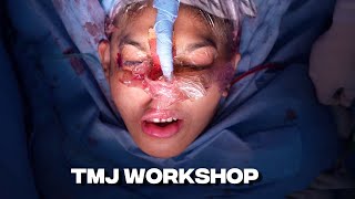 TMJ Total Joint Replacement Surgical Masterclass  Richardson Hospital Bangalore [upl. by Brine]