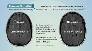 Science Bulletins New Tools Search for Lyme Disease in Brain [upl. by Yffub]