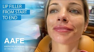 Lip Filler from Start to End [upl. by Littell]