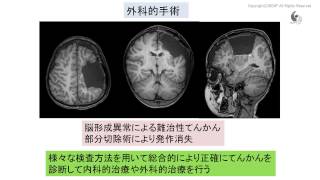 治験市民講座「てんかん治療と診断の最前線」：最新の治療や治験 [upl. by Yldarb680]