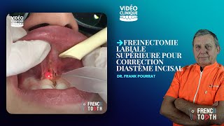 Freinectomie labiale supérieure pour correction diastème incisal  Dr Pourrat [upl. by Cormac]