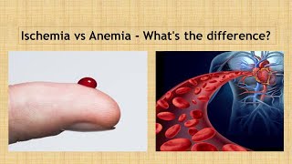 Ischemia vs Anaemia Simple way to learn [upl. by Ytsim]