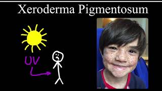 Xeroderma Pigmentosum [upl. by Matejka]