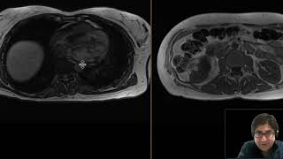 Renal angiomyolipoma [upl. by Maryn]