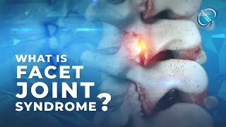 What is Facet Joint Syndrome [upl. by Nossila927]