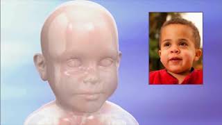 What is Hunter syndrome MPS II [upl. by Taft407]