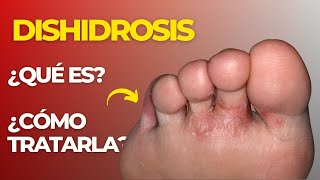 🚨 ¿DISHIDROSIS EN PODOLOGIA ¿Qué es y ¿Cómo TRATARLA👀 [upl. by Erreip]