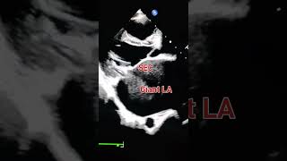 Echocardiography of Giant Left atrium LA amp spontaneous echo contrast ie SEC in RHD Severe MS [upl. by Thapa]