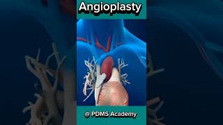 Heart Disease  Angioplasty procedure medicine [upl. by Eelrac52]