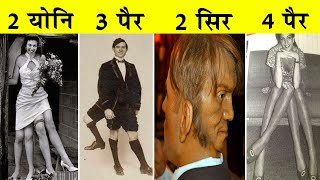 इन लोगों की कहानी सुनकर आपको रोना आ जाएगाThe Real Story Of Edward Mordrake The Man With Two Faces [upl. by Samira]