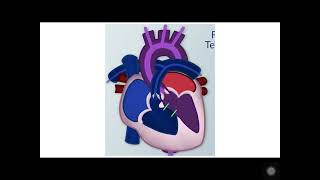 Tetralogy of fallot TOF [upl. by Yhcir]