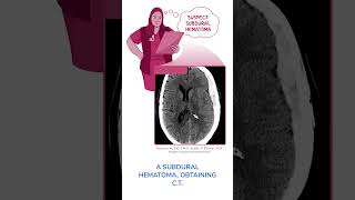 Diagnostics on Demand Subdural hematoma [upl. by Oedama]