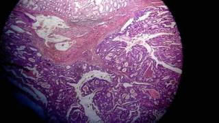 adenocarcinoma colon [upl. by Ahsinauj]