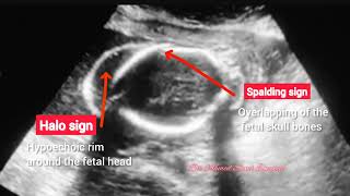 intrauterine fetal death ultrasound mnemonic [upl. by Ailadi]