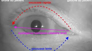 Nystagmus horizontorotatoire droit lors de la manœuvre diagnostique de DixHallpike VPPB 4ème [upl. by Rosse]