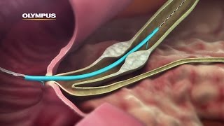 QuickPlaceV Biliary Stent [upl. by Melda]