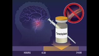 Tenecteplase for Ischemic Stroke at 45 to 24 Hours  NEJM [upl. by Uah978]