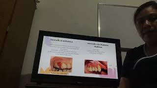 enfermedades periodontales parte 1 [upl. by Assetal]