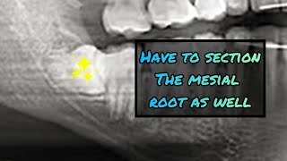 Black  White Version Quick StepByStep Extract of this Horizontally Impacted Wisdom Tooth [upl. by Attennek]