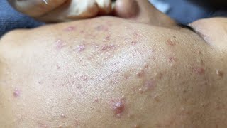 Blackheads amp Whiteheads Removal New 2024  Acne Treatment With Bo Nguyễn Spa 025 [upl. by Enerol945]