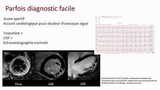 Une Myocardite • F Schnell Rennes [upl. by Ahsiekit]