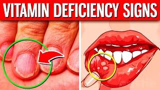 The 10 HIDDEN Signs Of Vitamin Deficiency You Should Never Ignore [upl. by Nnarual]