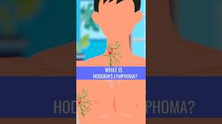 What is HODGKINS LYMPHOMA [upl. by Aremat363]