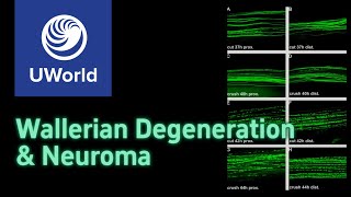 Wallerian degeneration amp neuroma  USMLE step 1 UWorld Questions Nervous system MBBS PLAB [upl. by Brenan]