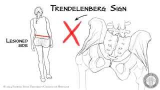 The Trendelenberg Sign HD [upl. by Charmine617]