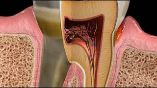 Abscess Periodontal [upl. by Suoicserp184]