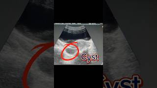 Bulky Uterus  Retroverted Uterus  Ovary Cyst  Simple Cyst on Ultrasound [upl. by O'Neill]