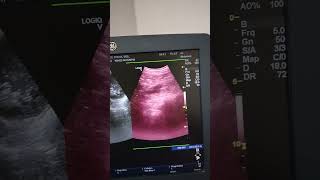 Supernumerary Kidney Ultrasound [upl. by Gerius]