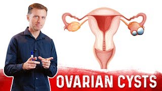 Ovarian Cysts Causes Symptoms amp Natural Treatment – DrBerg [upl. by Yesiad]