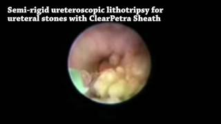 Litotricia con ureteroscopio semirígido para cálculos ureterales distales con vaina CLEARPETRA 2 [upl. by Reisch]