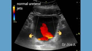 Ureteral or ureteric jets in bladder Ultrasound and color Doppler video [upl. by Iot265]