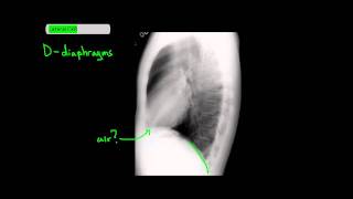 Method to Read Lateral Chest XRays UndergroundMed [upl. by Spiegelman514]