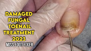 DAMAGED FUNGAL TOENAIL  Discoloration of the Nail  FULL TREATMENT BY MISS FOOT FIXER [upl. by Ahusoj]