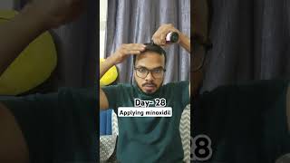 Day 28 Hair Regrowth journey Applying minoxidil bald minoxidil minoxidilresult hairloss [upl. by Yelsek]