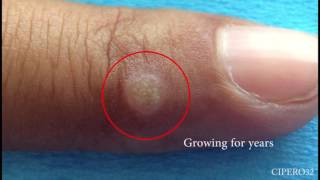 Wart Removal  Cryotherapy [upl. by Ettenyl]