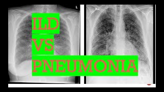 Chest Xray interstitial lung disease vs PneumoniaTypes of opacities in lungs [upl. by Staley572]