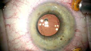 IZHV Iridozonular hyloid vitrectomy and Floaterectomy by Steven G Safran MD [upl. by Garlanda]