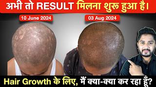 My 53 Days Hair Growth Journey  Hair Growth के लिए मैं क्याक्या कर रहा हूँ [upl. by Mchale798]